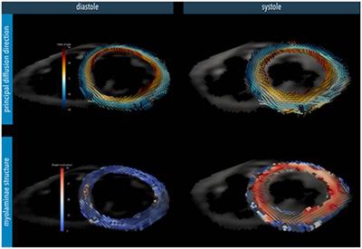 Myocardial Architecture, Mechanics, and Fibrosis in Congenital Heart Disease